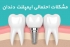 مشکلات احتمالی ایمپلنت دندان/عوامل موثر در عدم موفقیت ایمپلنت